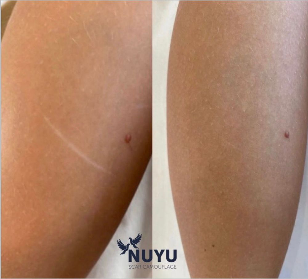 Before and after scar camouflage on a leg scar at Scargo Clinic