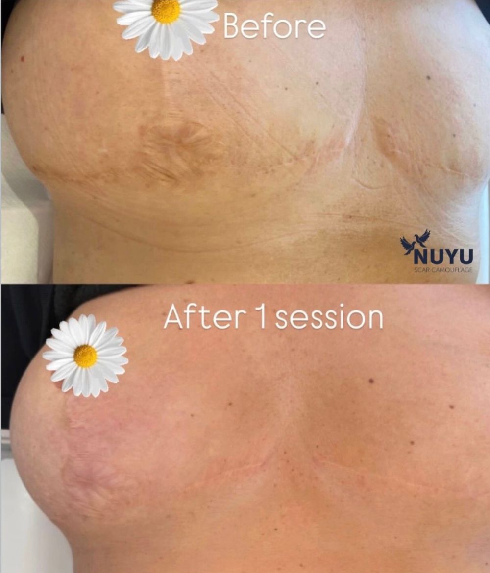 Before and after scar camouflage on breast reconstruction scars after one session at Scargo Clinic