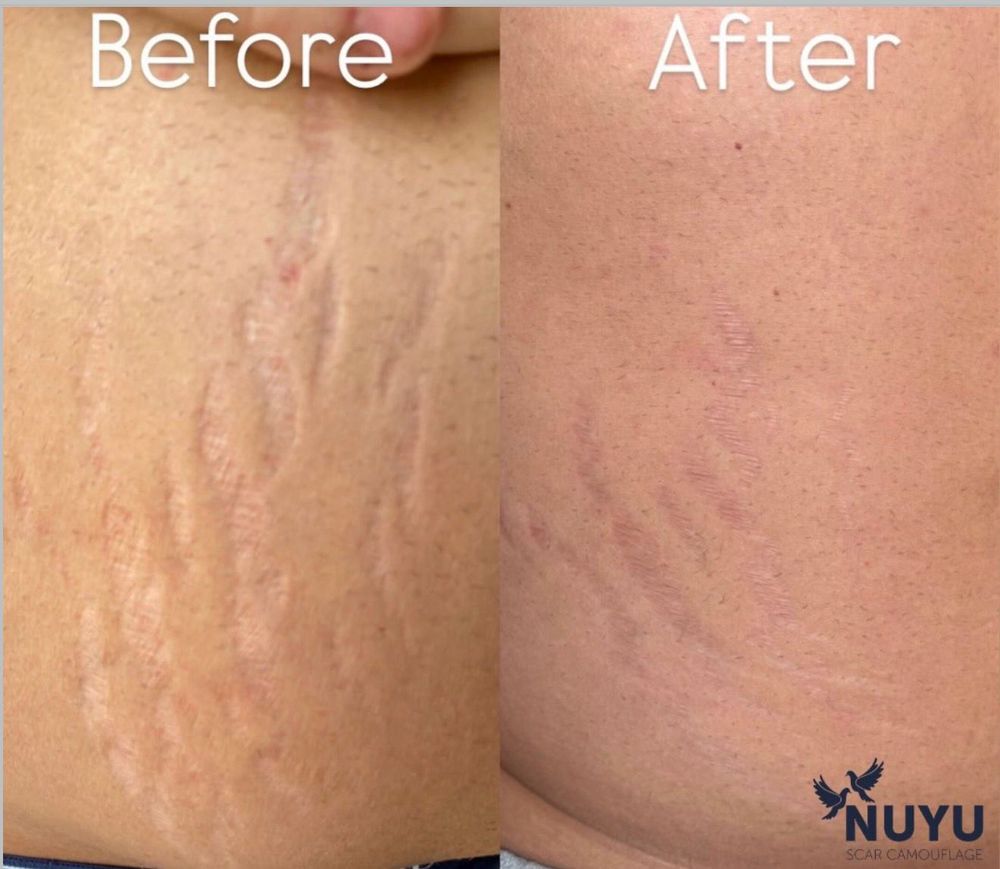 Before and after stretch mark camouflage on the stomach at Scargo Clinic